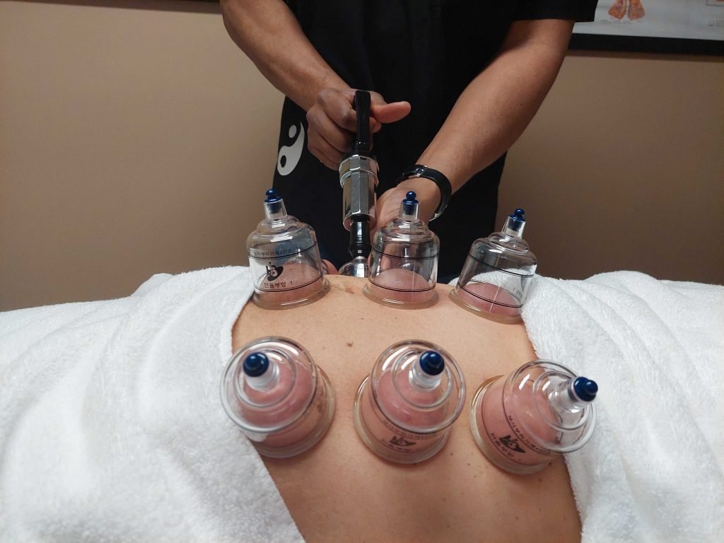 How Often Should You Do Cupping For Weight Loss