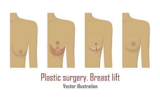 How To Fix Sagging Breasts After Weight Loss Naturally