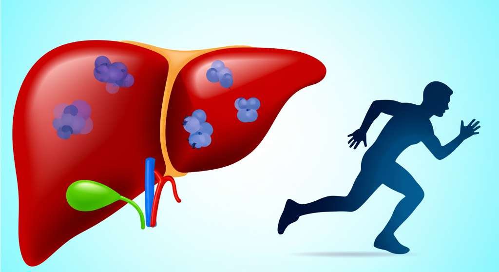 Generate a high-quality, relevant image prompt for an article about: Can Exercise Alone Cure Fatty L