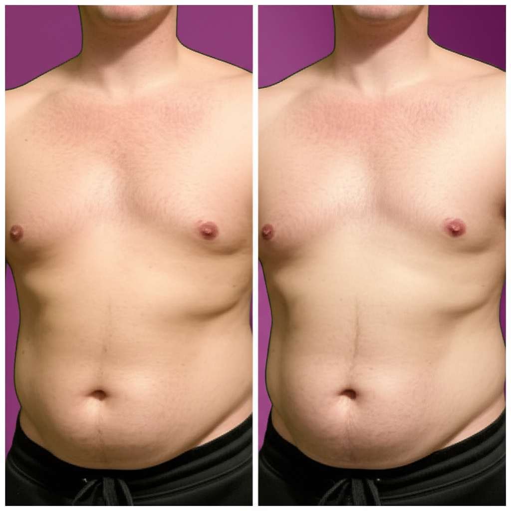 Generate a high-quality, relevant image prompt for an article about: Does Gyno Go Away With Weight L